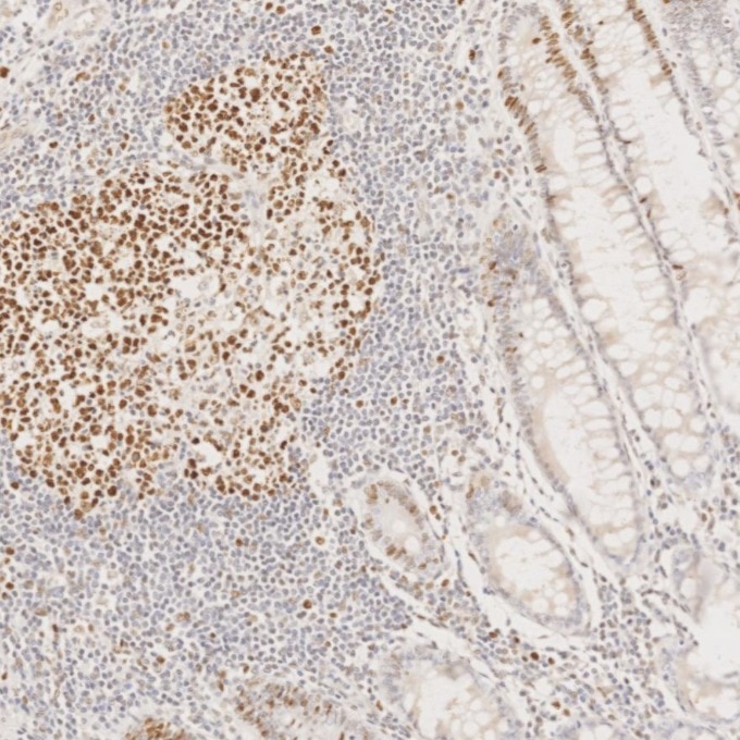 Immunohistochemistry (IHC) staining of human colorectal cancer tissue using MSH6 Monoclonal antibody (66172-2-Ig)