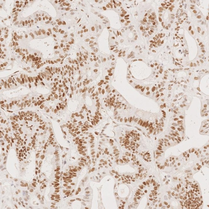 Immunohistochemistry (IHC) staining of human colorectal cancer tissue using MSH6 Monoclonal antibody (66172-2-Ig)