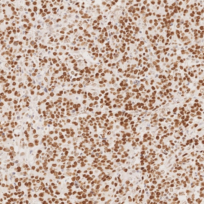 Immunohistochemistry (IHC) staining of human stomach cancer tissue using MSH6 Monoclonal antibody (66172-2-Ig)