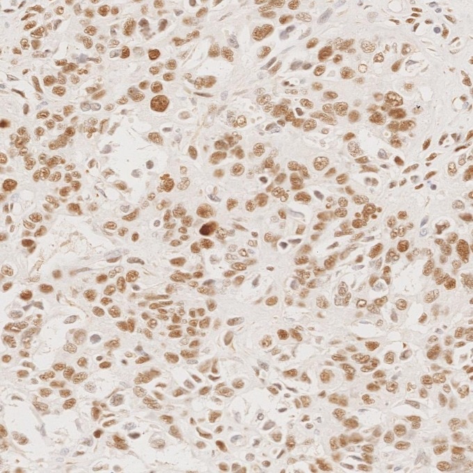 Immunohistochemistry (IHC) staining of human ovary cancer tissue using MSH6 Monoclonal antibody (66172-2-Ig)
