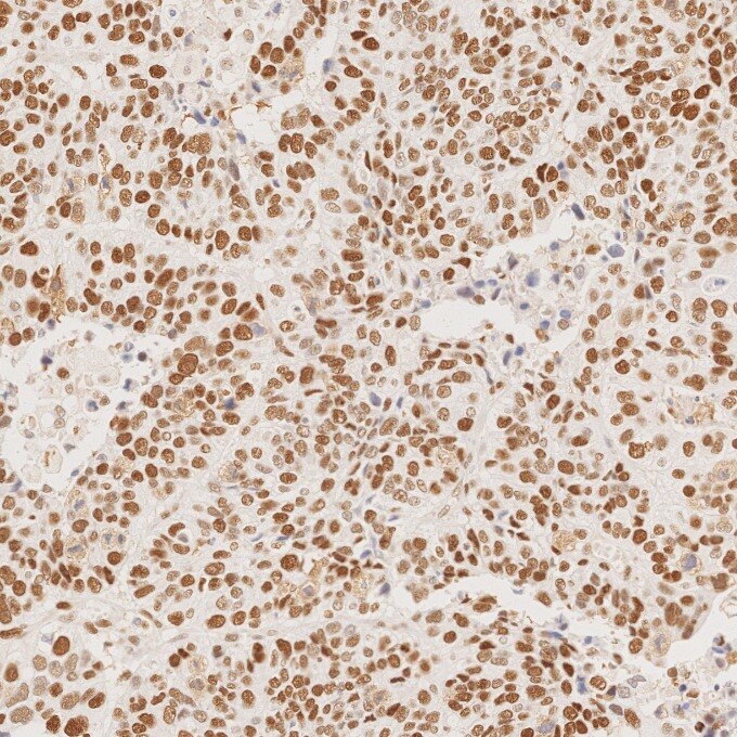 Immunohistochemistry (IHC) staining of human stomach cancer tissue using MSH6 Monoclonal antibody (66172-2-Ig)