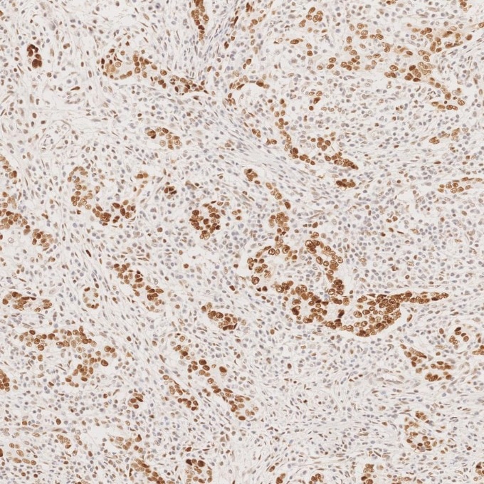 Immunohistochemistry (IHC) staining of human stomach cancer tissue using MSH6 Monoclonal antibody (66172-2-Ig)
