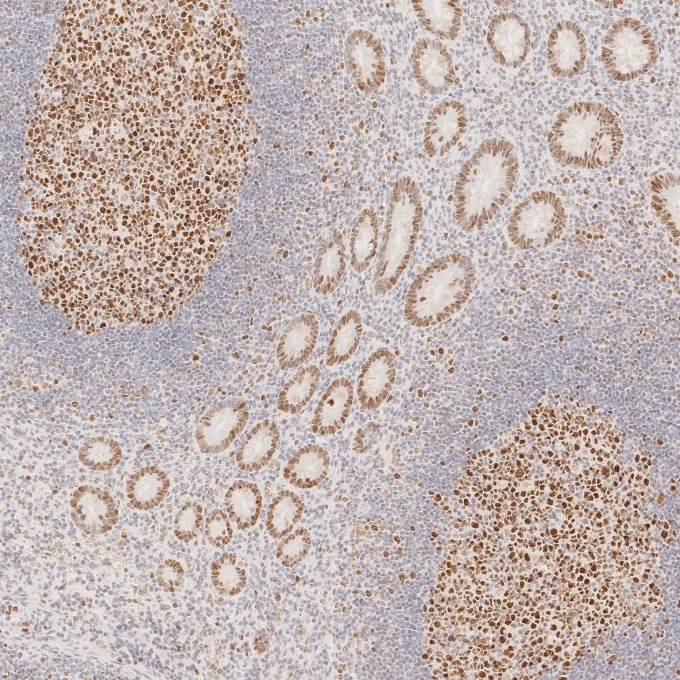Immunohistochemistry (IHC) staining of human appendicitis tissue using MSH6 Monoclonal antibody (66172-2-Ig)