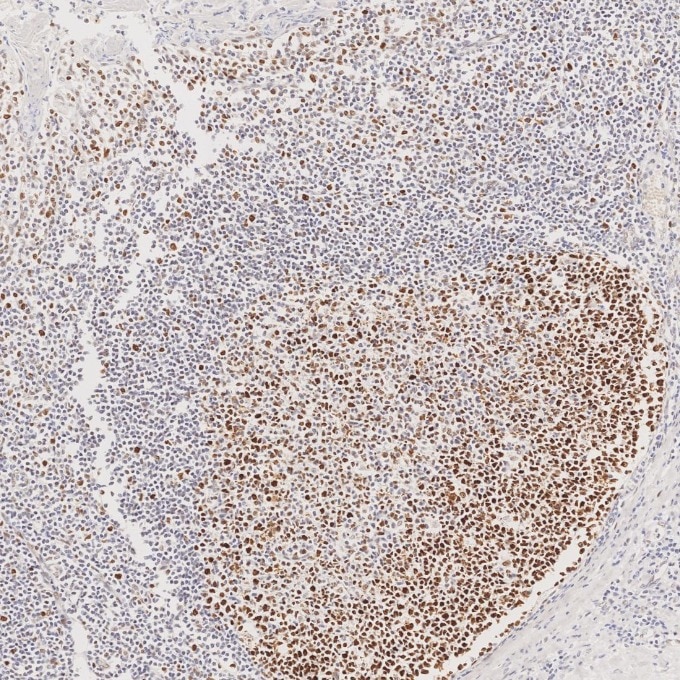 Immunohistochemistry (IHC) staining of human tonsillitis tissue using MSH6 Monoclonal antibody (66172-2-Ig)
