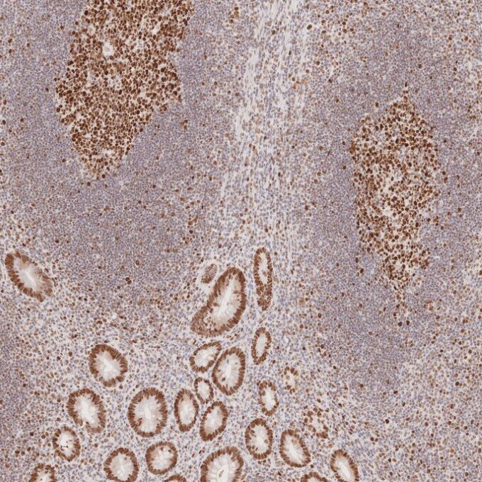 Immunohistochemistry (IHC) staining of human appendicitis tissue using MSH6 Monoclonal antibody (66172-2-Ig)