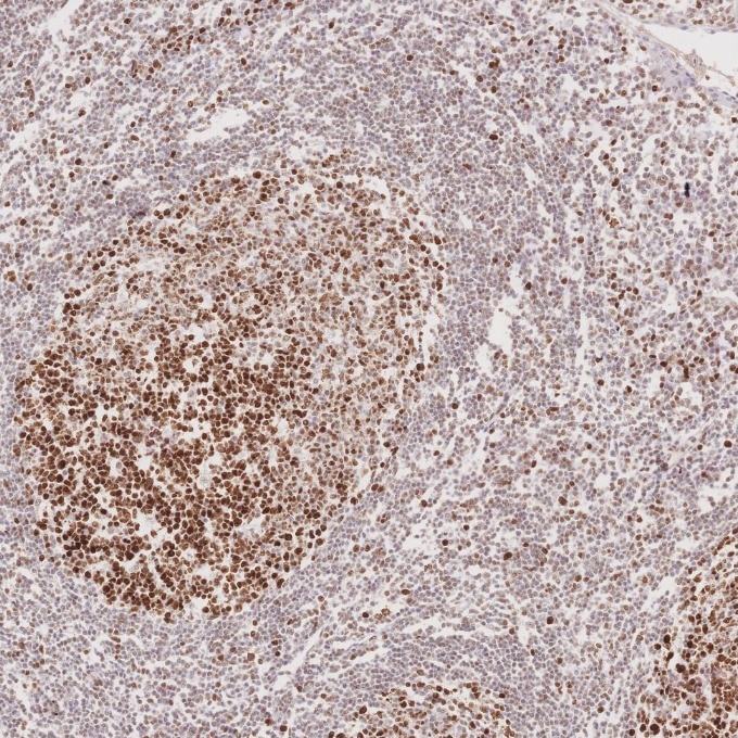 Immunohistochemistry (IHC) staining of human tonsillitis tissue using MSH6 Monoclonal antibody (66172-2-Ig)
