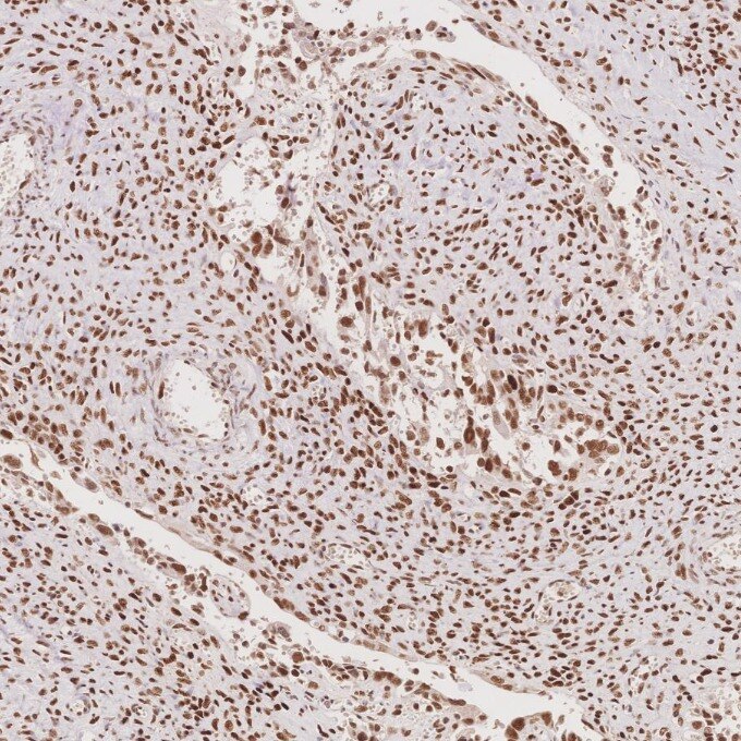 Immunohistochemistry (IHC) staining of human ovary cancer tissue using MSH6 Monoclonal antibody (66172-2-Ig)