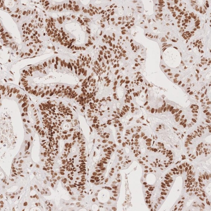 Immunohistochemistry (IHC) staining of human colorectal cancer tissue using MSH6 Monoclonal antibody (66172-2-Ig)