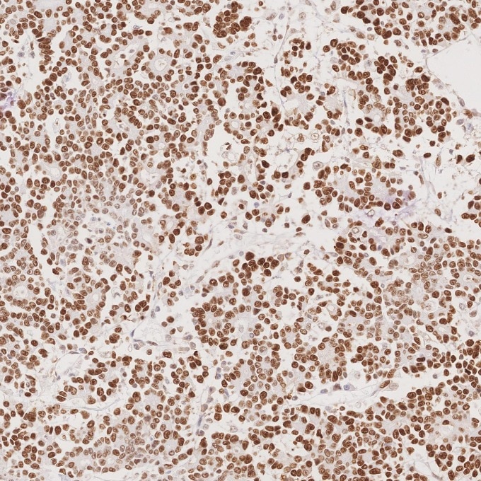 Immunohistochemistry (IHC) staining of human stomach cancer tissue using MSH6 Monoclonal antibody (66172-2-Ig)