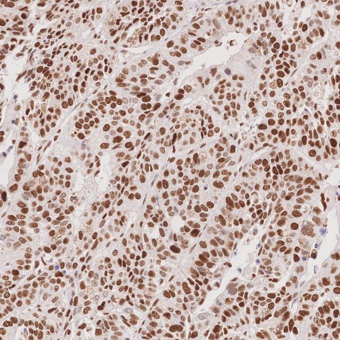 Immunohistochemistry (IHC) staining of human stomach cancer tissue using MSH6 Monoclonal antibody (66172-2-Ig)