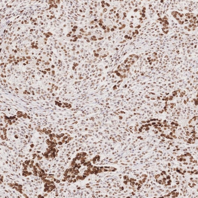 Immunohistochemistry (IHC) staining of human stomach cancer tissue using MSH6 Monoclonal antibody (66172-2-Ig)