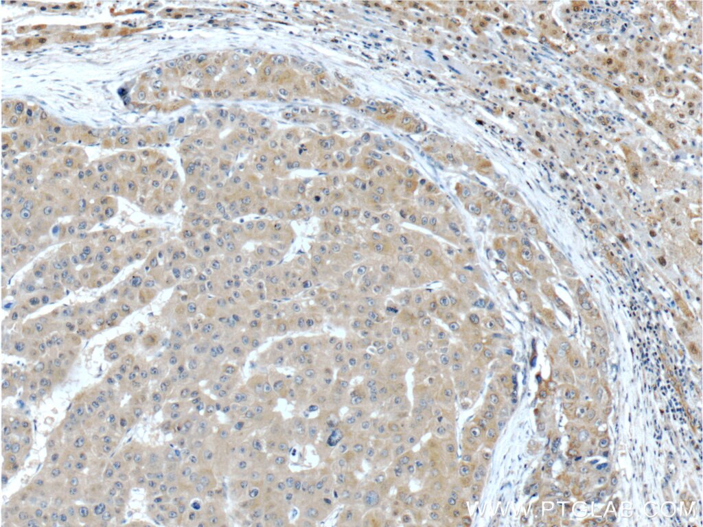 Immunohistochemistry (IHC) staining of human liver cancer tissue using MSI1 Polyclonal antibody (20579-1-AP)