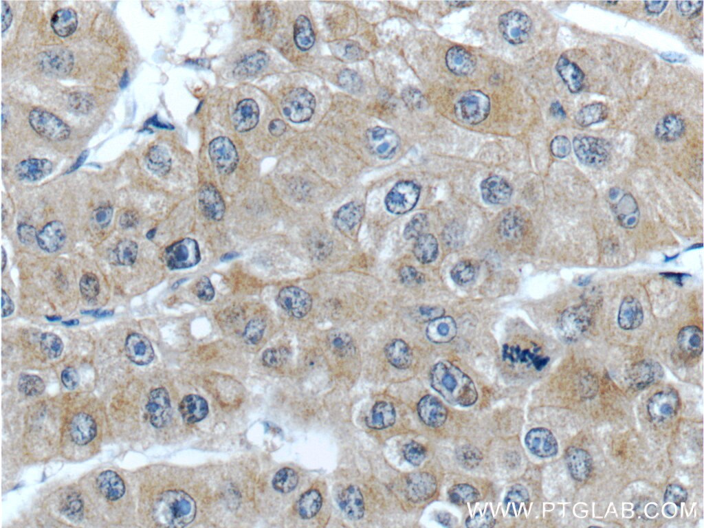 Immunohistochemistry (IHC) staining of human liver cancer tissue using MSI1 Polyclonal antibody (20579-1-AP)