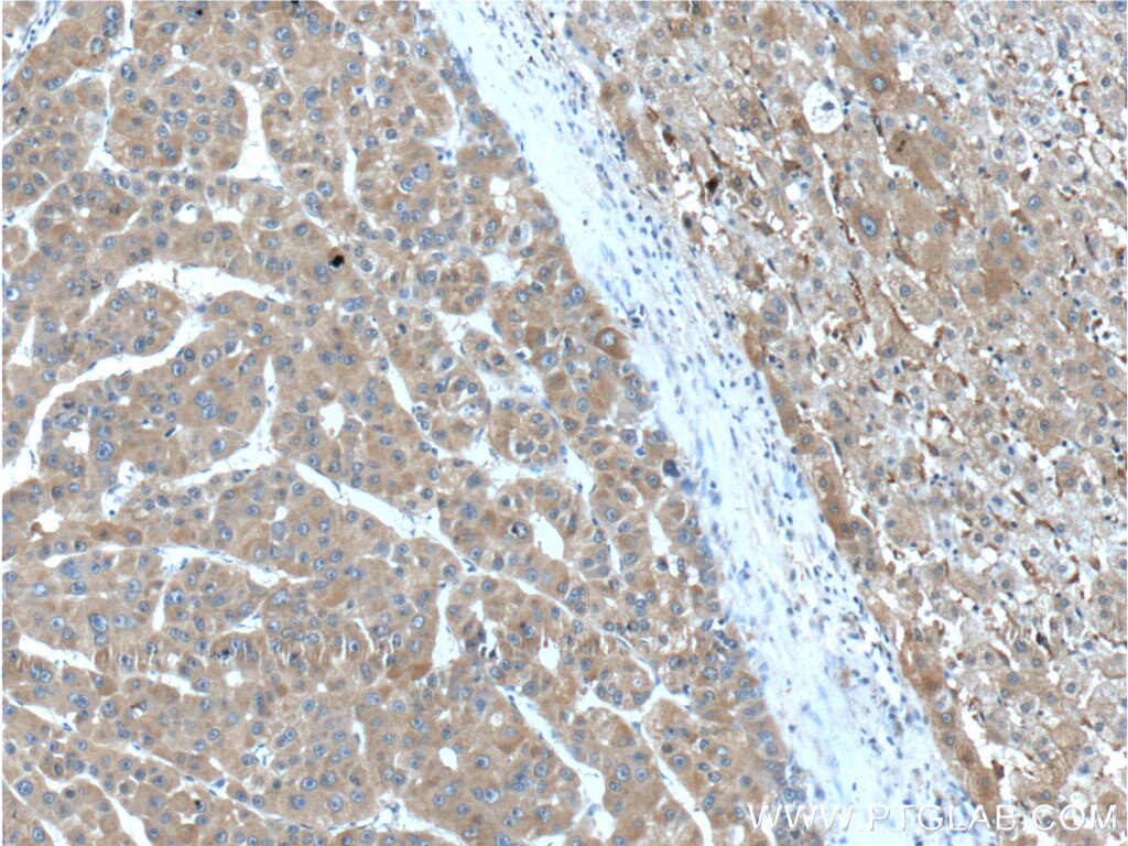 Immunohistochemistry (IHC) staining of human liver cancer tissue using MSI1 Polyclonal antibody (20579-1-AP)