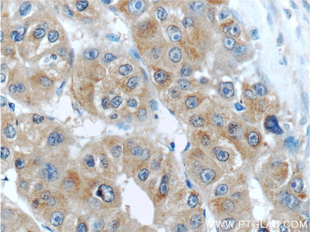 Immunohistochemistry (IHC) staining of human liver cancer tissue using MSI1 Polyclonal antibody (20579-1-AP)