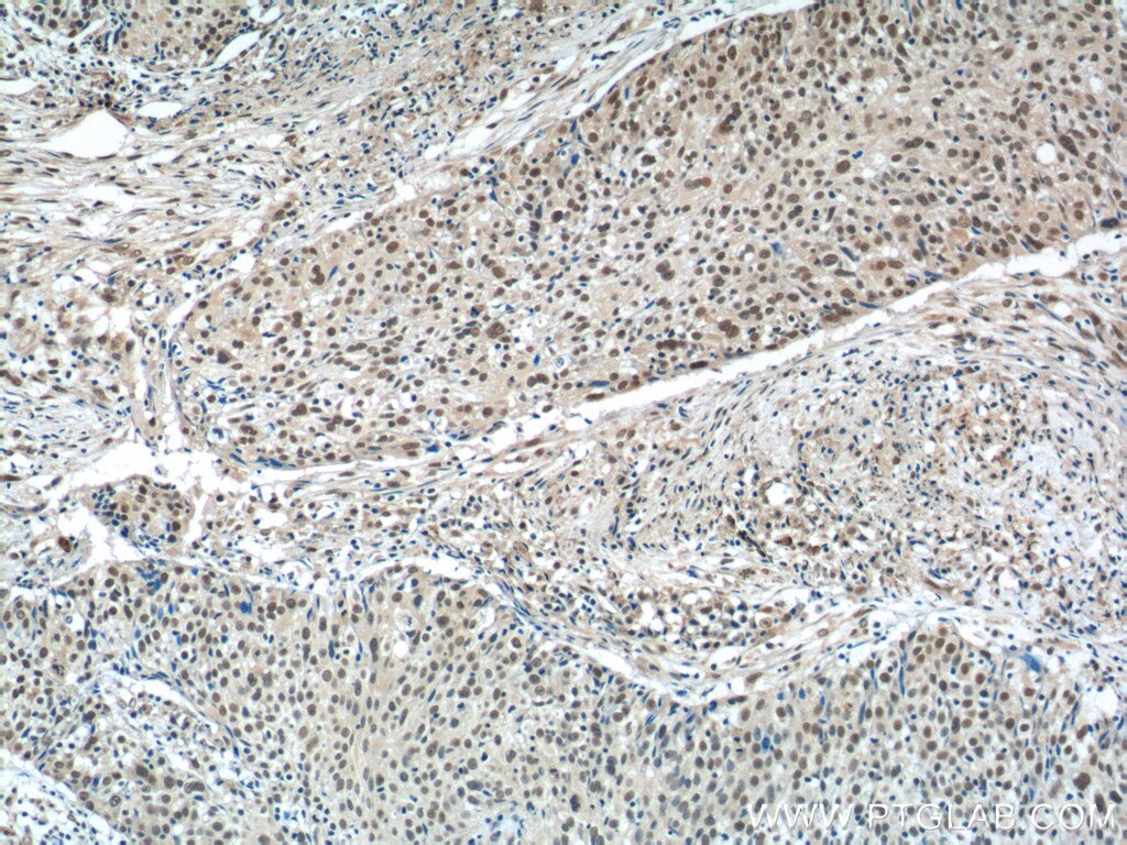 Immunohistochemistry (IHC) staining of human lung cancer tissue using MSI1 Polyclonal antibody (20579-1-AP)