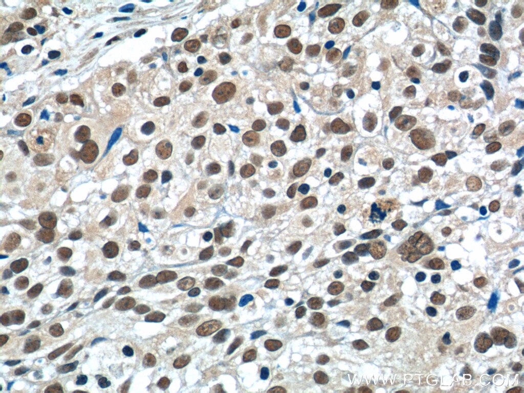 Immunohistochemistry (IHC) staining of human lung cancer tissue using MSI1 Polyclonal antibody (20579-1-AP)