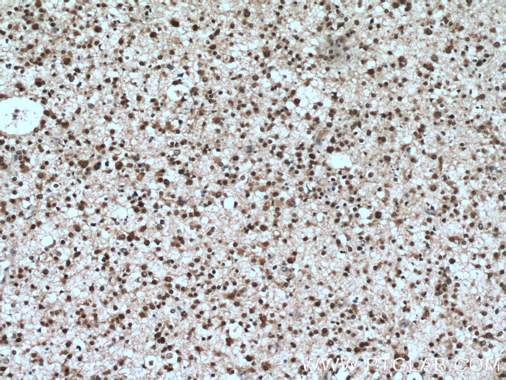 Immunohistochemistry (IHC) staining of human gliomas tissue using MSI1 Polyclonal antibody (27185-1-AP)