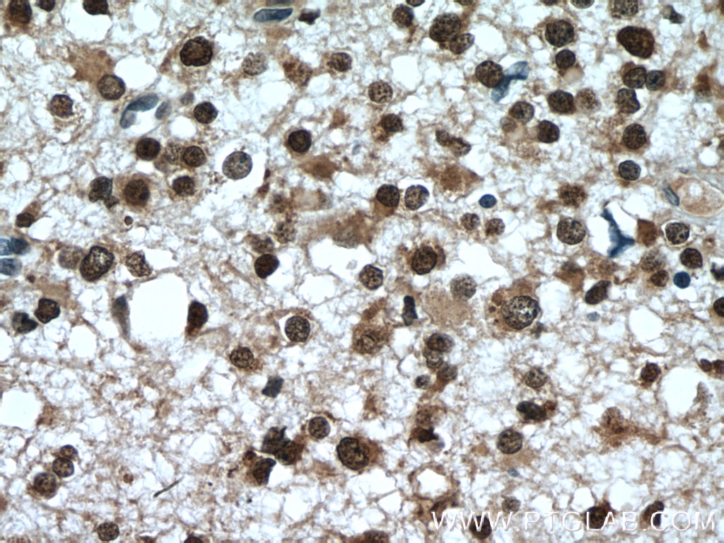 Immunohistochemistry (IHC) staining of human gliomas tissue using MSI1 Polyclonal antibody (27185-1-AP)