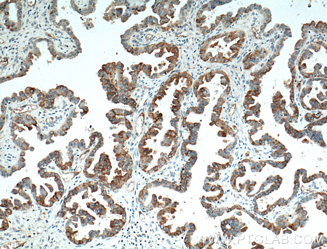 Immunohistochemistry (IHC) staining of human ovary tumor tissue using Mesothelin Monoclonal antibody (66404-1-Ig)