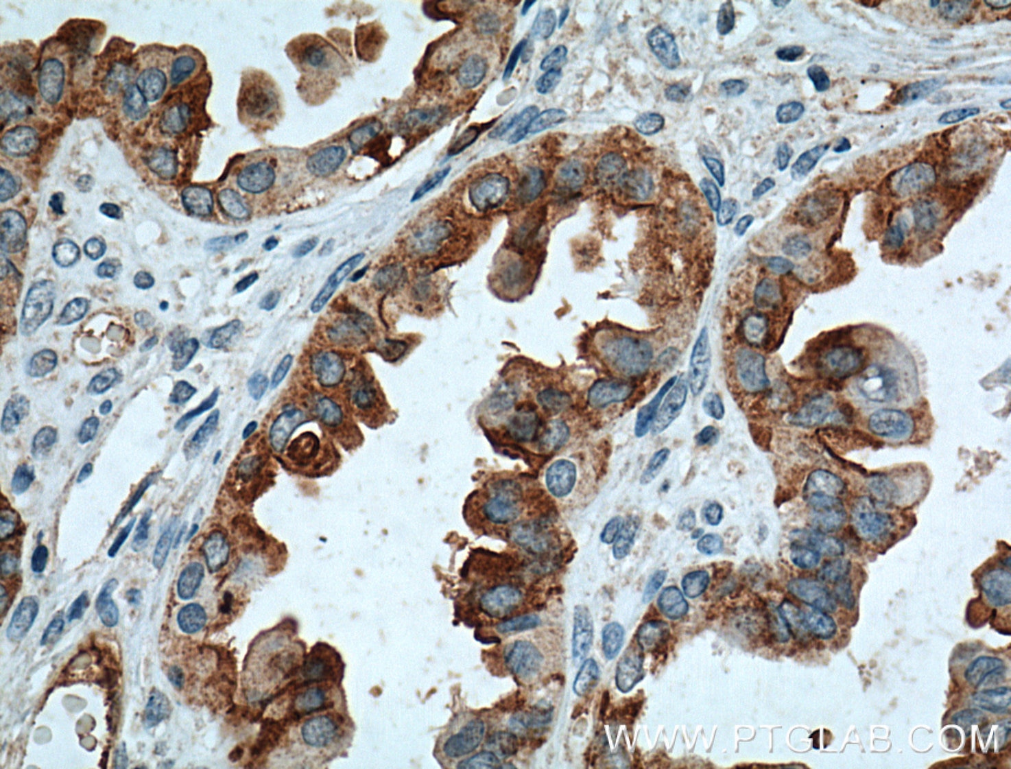 Immunohistochemistry (IHC) staining of human ovary tumor tissue using Mesothelin Monoclonal antibody (66404-1-Ig)