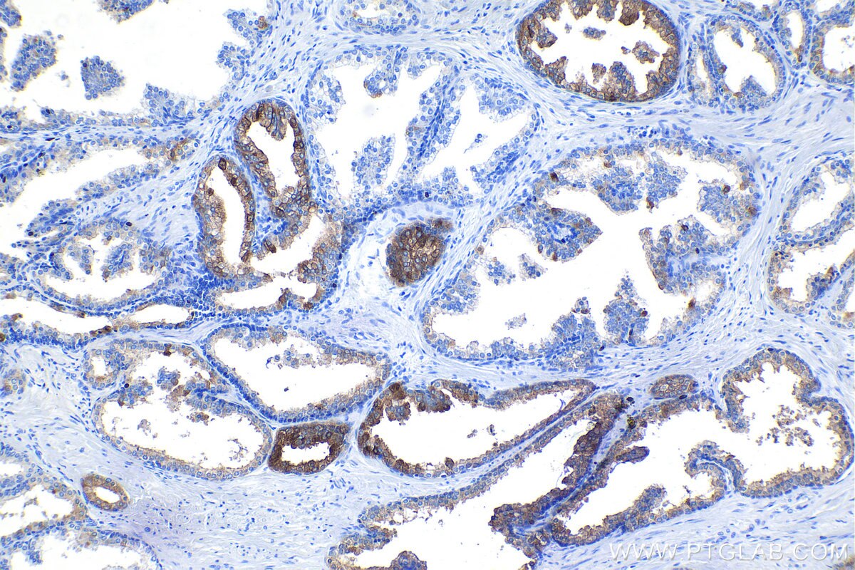 Immunohistochemistry (IHC) staining of human prostate hyperplasia tissue using MSMB Polyclonal antibody (15888-1-AP)