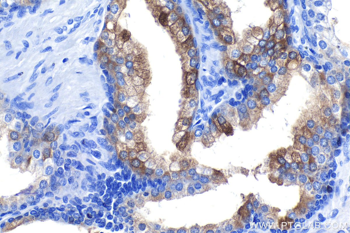 Immunohistochemistry (IHC) staining of human prostate hyperplasia tissue using MSMB Polyclonal antibody (15888-1-AP)