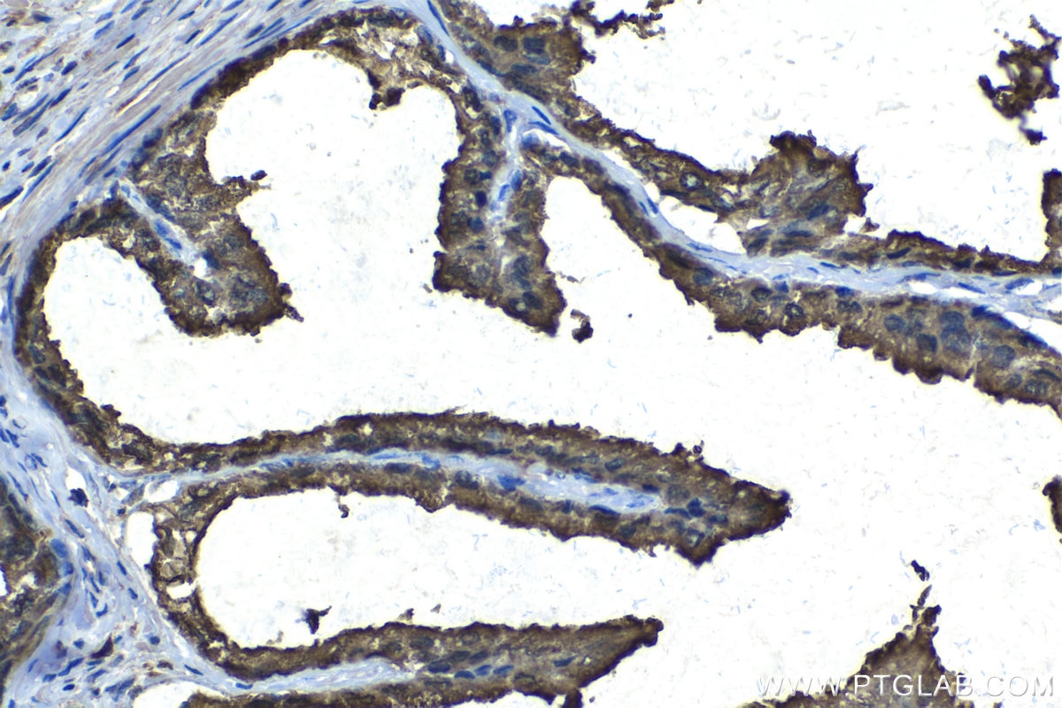 Immunohistochemistry (IHC) staining of human prostate cancer tissue using MSMB Polyclonal antibody (15888-1-AP)