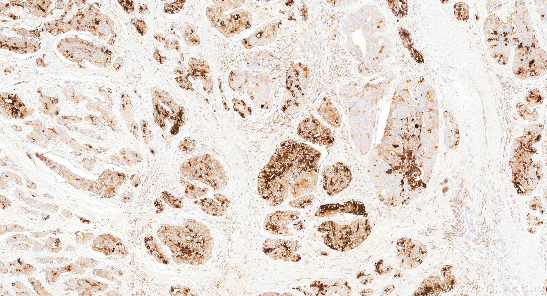 IHC staining of human prostate cancer using 87375-1-RR (same clone as 87375-1-PBS) Immunohistochemistry (IHC) staining of human prostate cancer tissue using MSMB Recombinant monoclonal antibody (87375-1-RR)