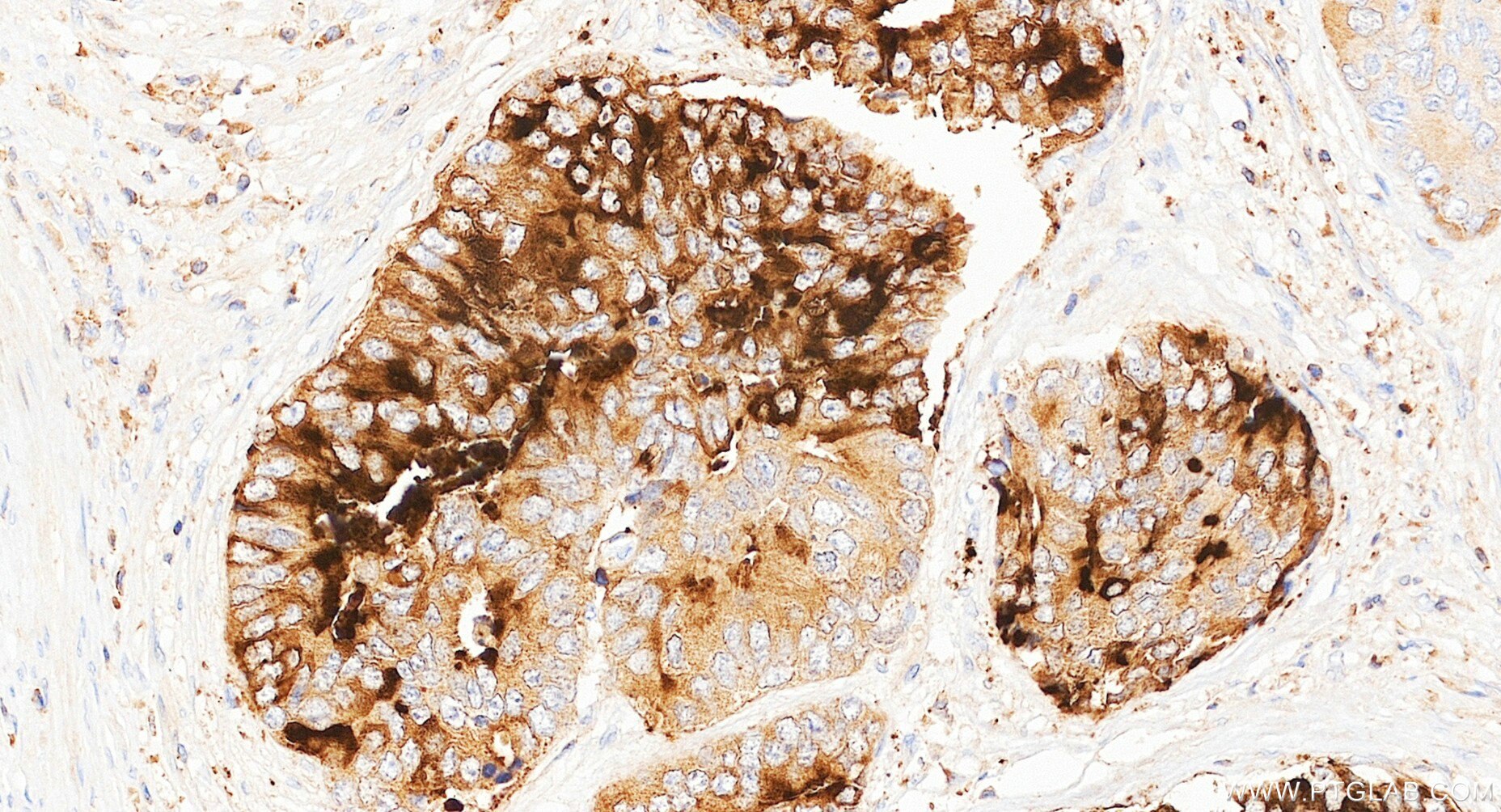 IHC staining of human prostate cancer using 87375-1-RR (same clone as 87375-1-PBS) Immunohistochemistry (IHC) staining of human prostate cancer tissue using MSMB Recombinant monoclonal antibody (87375-1-RR)