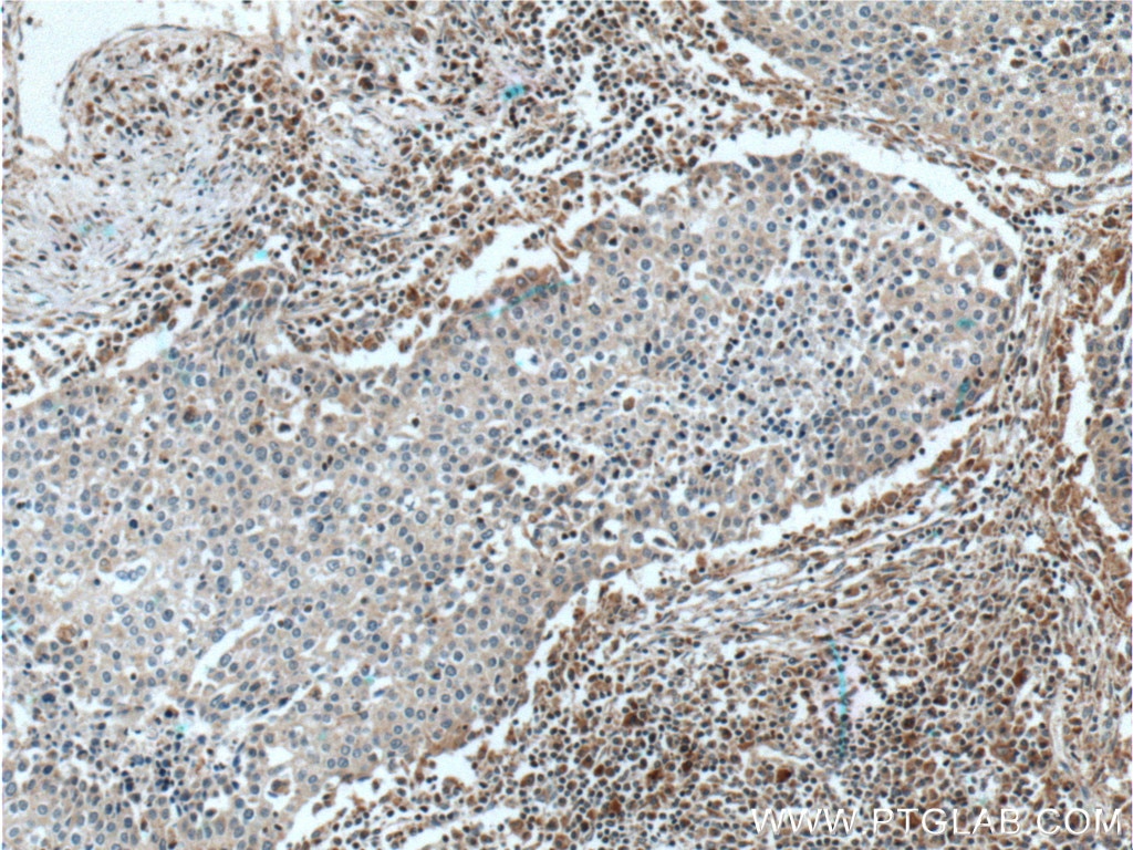 Immunohistochemistry (IHC) staining of human lung cancer tissue using RON, MST1R Polyclonal antibody (11053-1-AP)