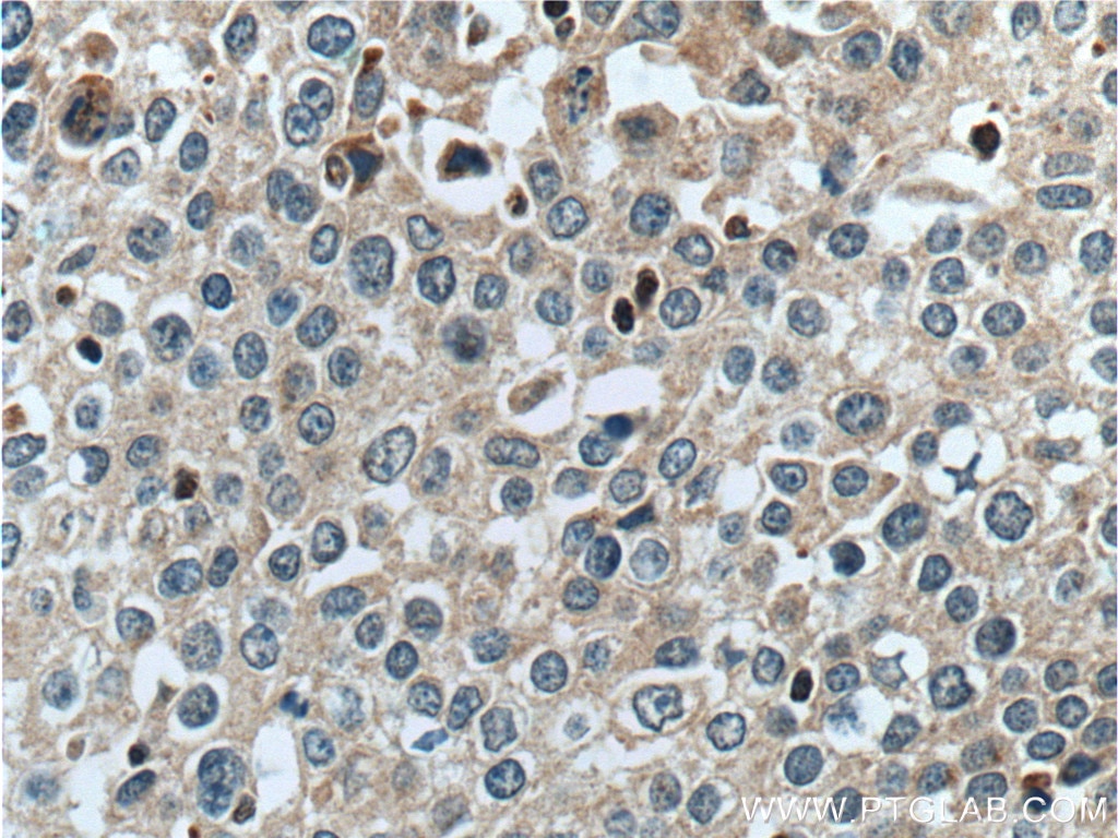 Immunohistochemistry (IHC) staining of human lung cancer tissue using RON, MST1R Polyclonal antibody (11053-1-AP)