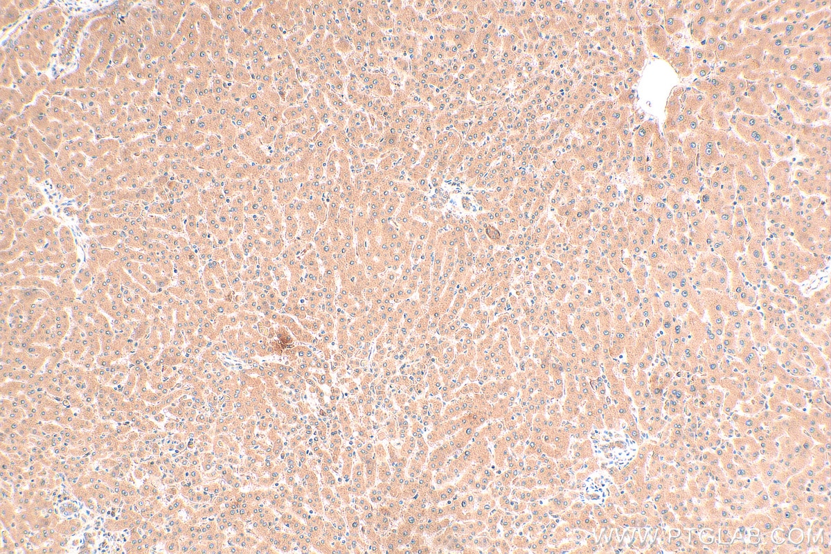 Immunohistochemistry (IHC) staining of human hepatocirrhosis tissue using MT1X Polyclonal antibody (17172-1-AP)