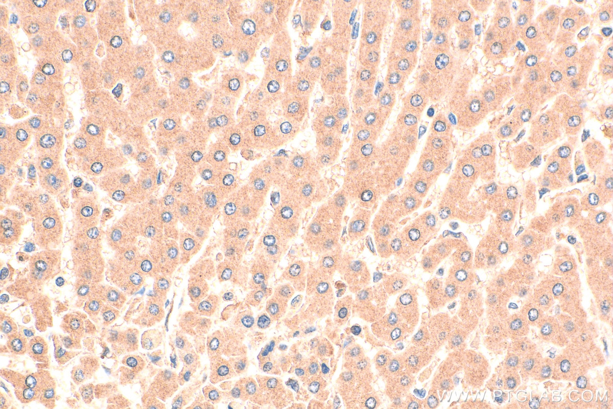 Immunohistochemistry (IHC) staining of human hepatocirrhosis tissue using MT1X Polyclonal antibody (17172-1-AP)