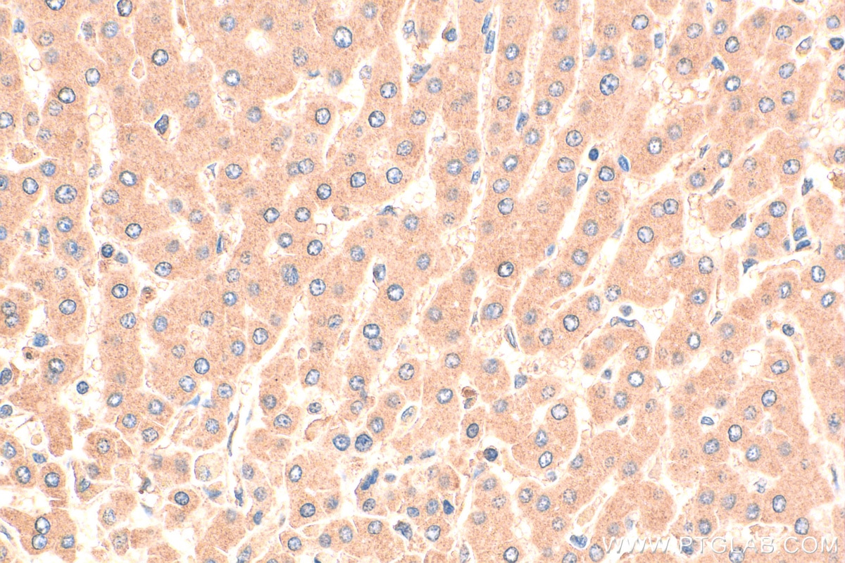 IHC staining of human hepatocirrhosis using 17172-1-AP