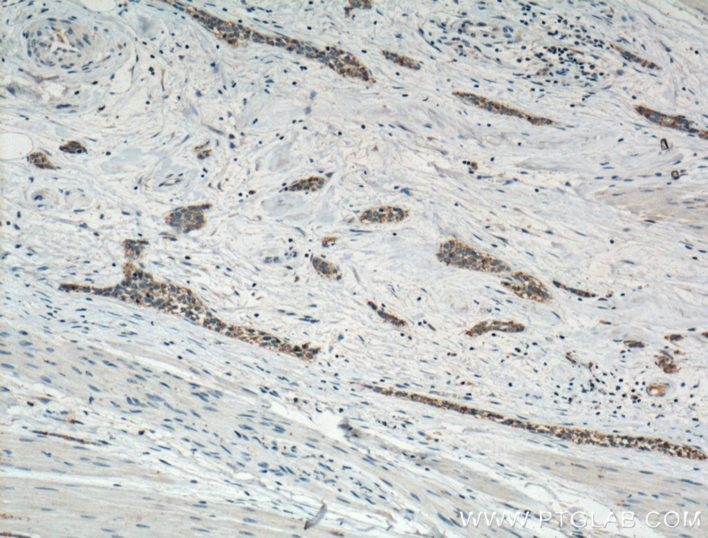 Immunohistochemistry (IHC) staining of human urothelial carcinoma tissue using MT2A Polyclonal antibody (20809-1-AP)