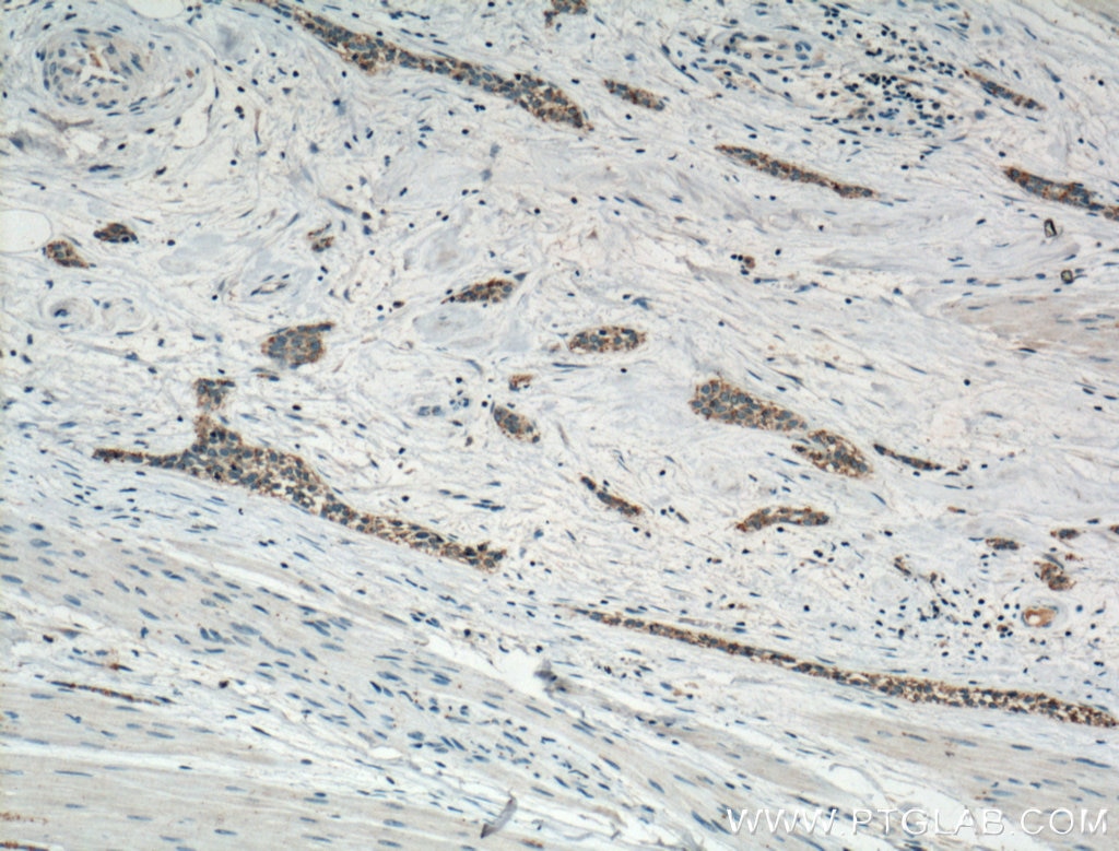 IHC staining of human urothelial carcinoma using 20809-1-AP