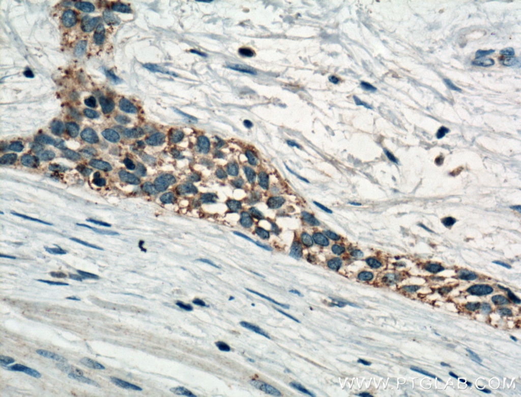 Immunohistochemistry (IHC) staining of human urothelial carcinoma tissue using MT2A Polyclonal antibody (20809-1-AP)