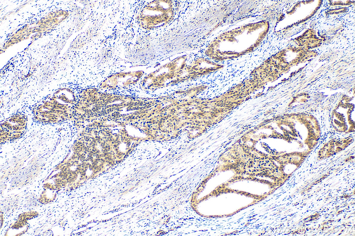 Immunohistochemistry (IHC) staining of human prostate cancer tissue using MTA1 Polyclonal antibody (30545-1-AP)