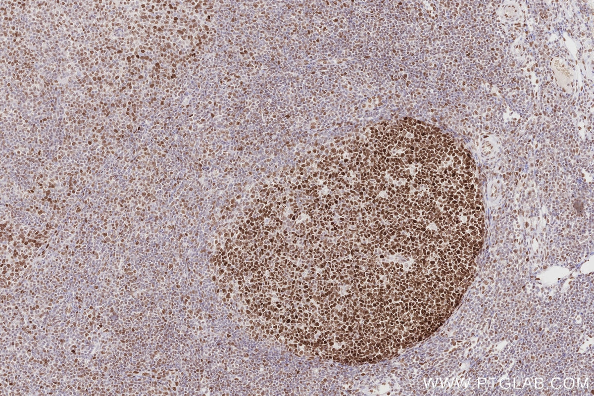 IHC staining of human tonsillitis using 83042-3-RR Immunohistochemistry (IHC) staining of human tonsillitis tissue using MTA3 Recombinant monoclonal antibody (83042-3-RR)