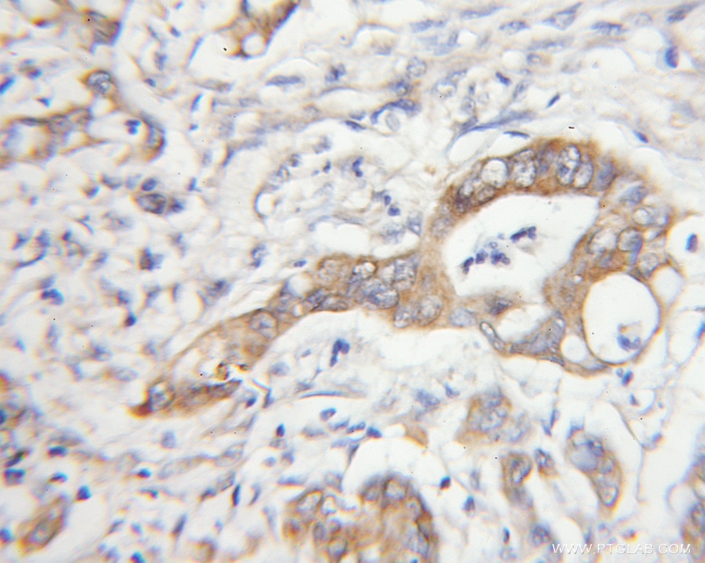 Immunohistochemistry (IHC) staining of human colon cancer tissue using MTAP Polyclonal antibody (11475-1-AP)