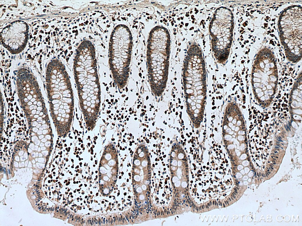 IHC staining of human colon cancer using 66706-1-Ig
