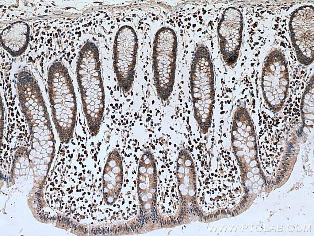 Immunohistochemistry (IHC) staining of human colon cancer tissue using MTAP Monoclonal antibody (66706-1-Ig)