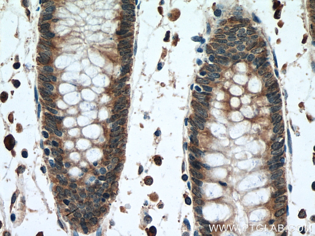 Immunohistochemistry (IHC) staining of human colon cancer tissue using MTAP Monoclonal antibody (66706-1-Ig)