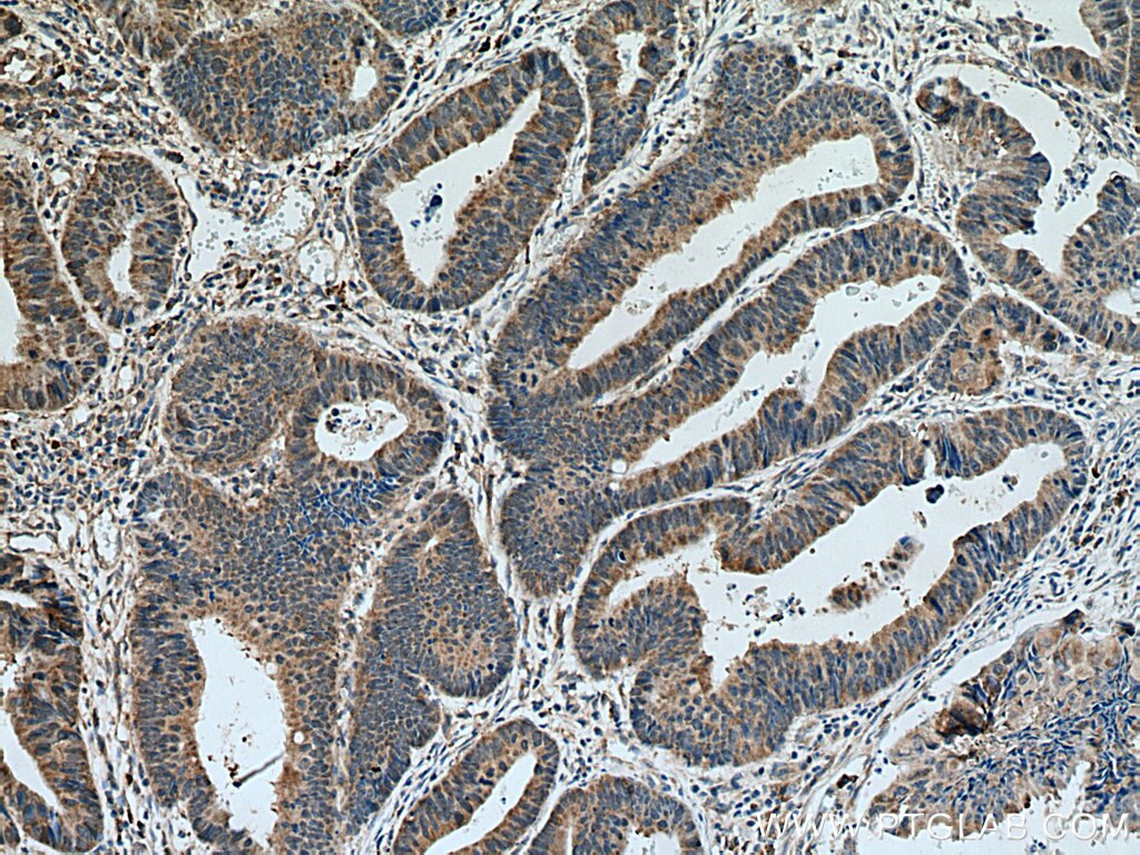 Immunohistochemistry (IHC) staining of human colon cancer tissue using MTAP Monoclonal antibody (66706-1-Ig)