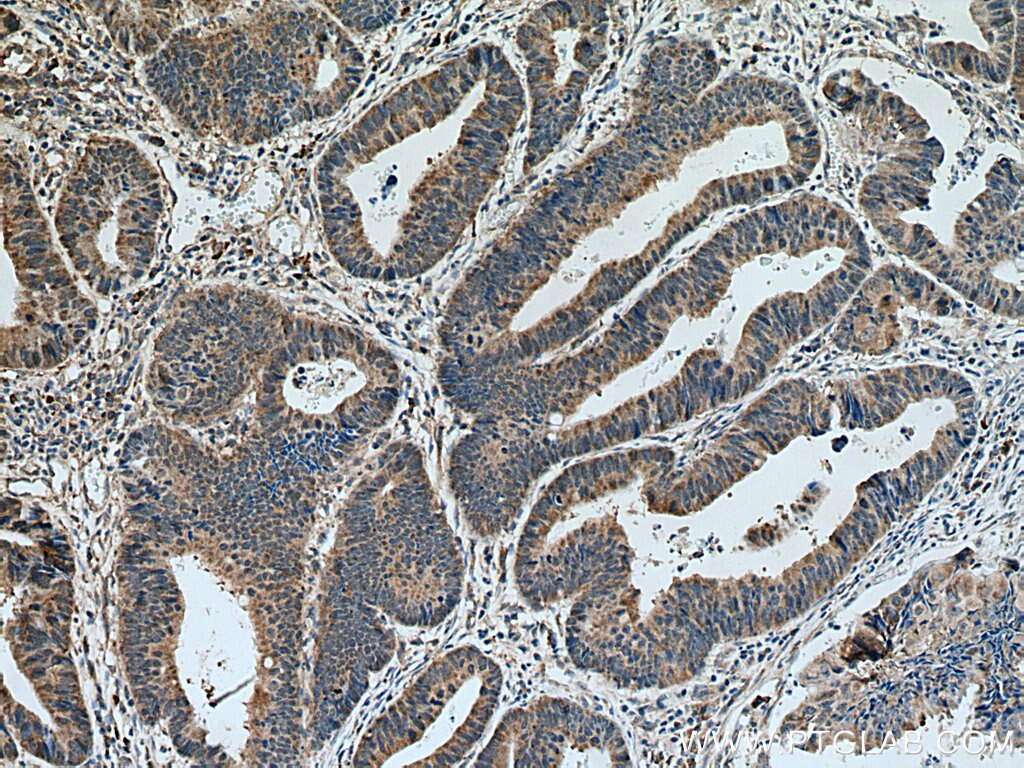 IHC staining of human colon cancer using 66706-1-Ig