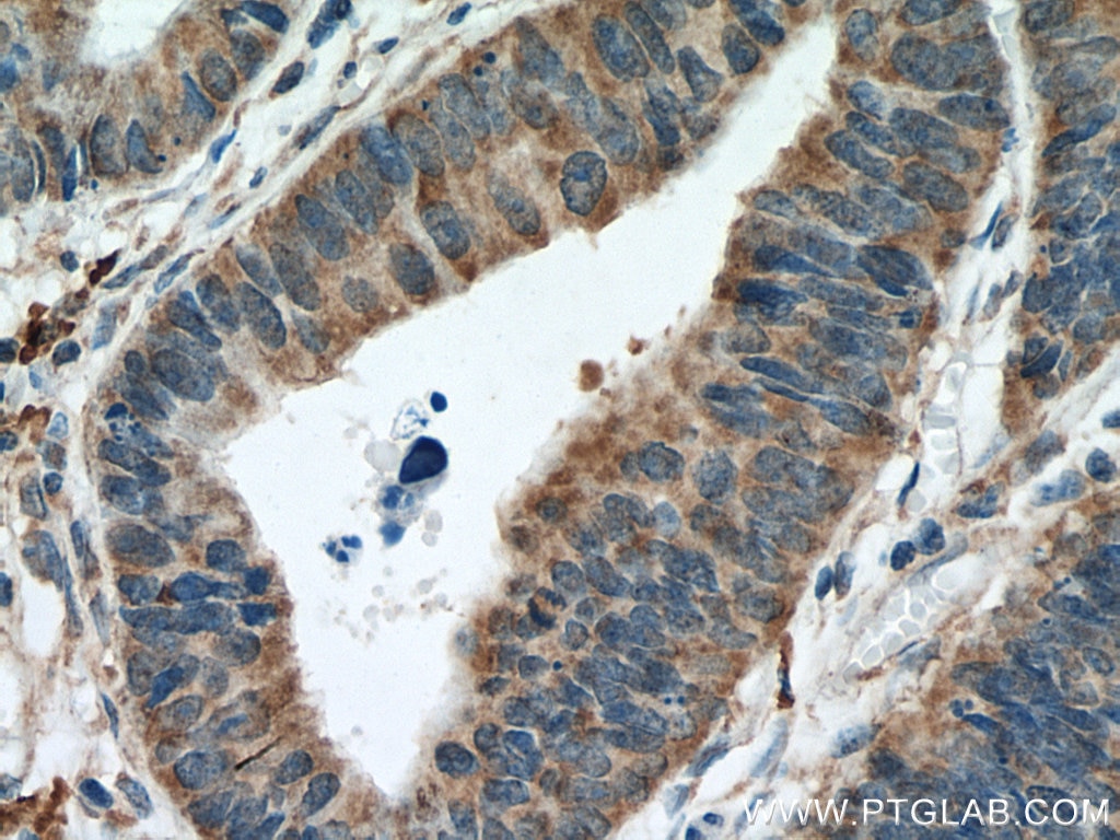 Immunohistochemistry (IHC) staining of human colon cancer tissue using MTAP Monoclonal antibody (66706-1-Ig)