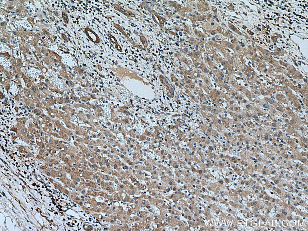 Immunohistochemistry (IHC) staining of human liver cancer tissue using MTAP Monoclonal antibody (66706-1-Ig)