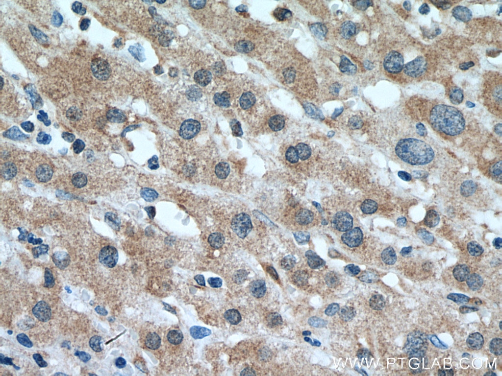 Immunohistochemistry (IHC) staining of human liver cancer tissue using MTAP Monoclonal antibody (66706-1-Ig)