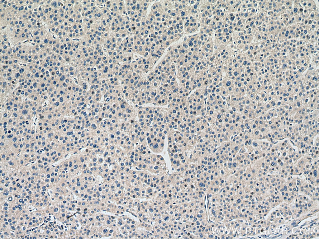 Immunohistochemistry (IHC) staining of human liver cancer tissue using MTAP Monoclonal antibody (66706-1-Ig)